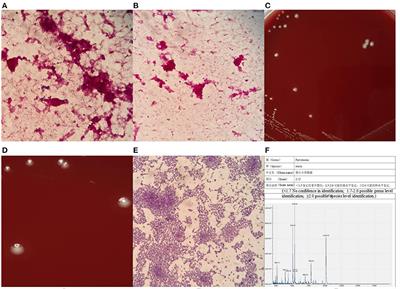 A case report of sepsis and death caused by Parvimonas micra, a rare anaerobe